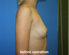 plastic-surgery-breast-augmentation