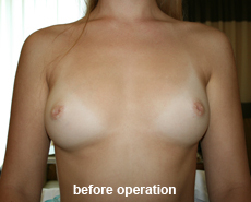 plastic-surgery-breast-augmentation