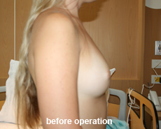 plastic-surgery-breast-augmentation