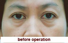 plastic-surgery-blepharoplasty