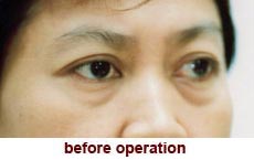 plastic-surgery-blepharoplasty