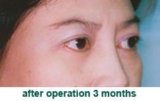 plastic-surgery-blepharoplasty