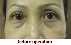 plastic-surgery-blepharoplasty