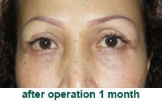 plastic-surgery-blepharoplasty