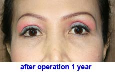 plastic-surgery-blepharoplasty