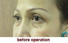 plastic-surgery-blepharoplasty