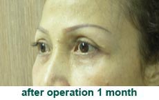 plastic-surgery-blepharoplasty