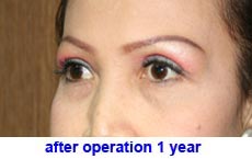 plastic-surgery-blepharoplasty