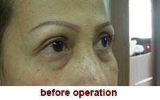 plastic-surgery-blepharoplasty