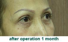 plastic-surgery-blepharoplasty