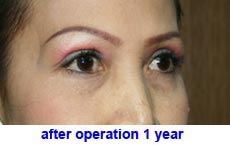 plastic-surgery-blepharoplasty