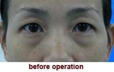 plastic-surgery-blepharoplasty