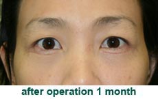 plastic-surgery-blepharoplasty