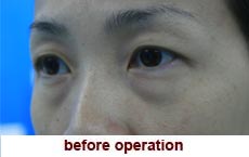 plastic-surgery-blepharoplasty