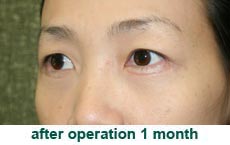 plastic-surgery-blepharoplasty