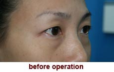 plastic-surgery-blepharoplasty