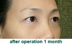 plastic-surgery-blepharoplasty