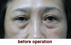 plastic-surgery-blepharoplasty