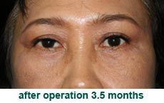 plastic-surgery-blepharoplasty