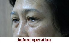 plastic-surgery-blepharoplasty