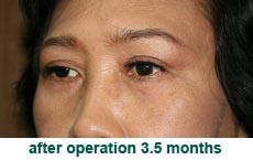 plastic-surgery-blepharoplasty