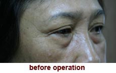 plastic-surgery-blepharoplasty