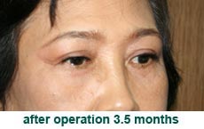 plastic-surgery-blepharoplasty