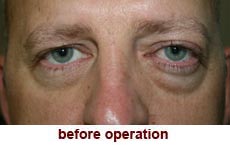 plastic-surgery-blepharoplasty