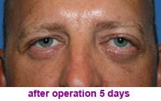 plastic-surgery-blepharoplasty