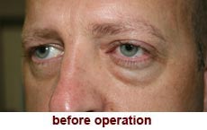 plastic-surgery-blepharoplasty