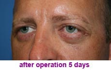 plastic-surgery-blepharoplasty