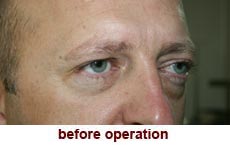 plastic-surgery-blepharoplasty