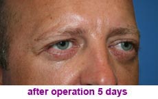 plastic-surgery-blepharoplasty