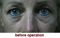 plastic-surgery-blepharoplasty