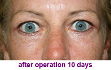 plastic-surgery-blepharoplasty