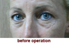 plastic-surgery-blepharoplasty