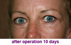 plastic-surgery-blepharoplasty