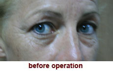 plastic-surgery-blepharoplasty