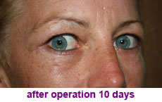 plastic-surgery-blepharoplasty