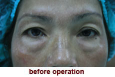 plastic-surgery-blepharoplasty