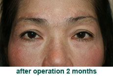 plastic-surgery-blepharoplasty