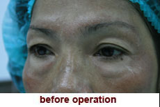 plastic-surgery-blepharoplasty