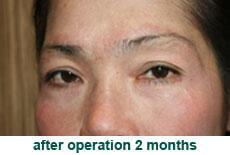 plastic-surgery-blepharoplasty