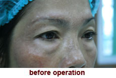 plastic-surgery-blepharoplasty