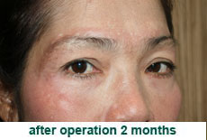 plastic-surgery-blepharoplasty