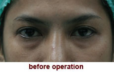 plastic-surgery-blepharoplasty