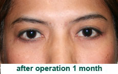 plastic-surgery-blepharoplasty