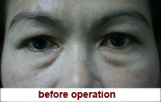 plastic-surgery-blepharoplasty