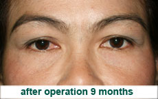 plastic-surgery-blepharoplasty