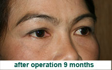 plastic-surgery-blepharoplasty